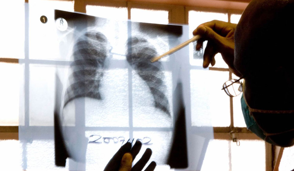 Bharat Biotech takes giant leap with tuberculosis vaccine, starts clinical trials in India - Vimarsana News