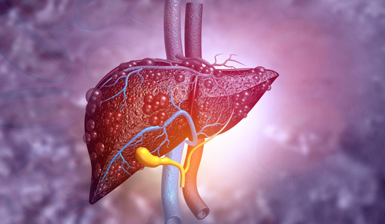 World Hepatitis Day 2023: No alcohol is good for liver - Vimarsana News
