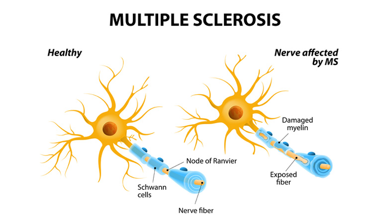 Signs of multiple sclerosis show up in blood years before symptoms - Vimarsana News