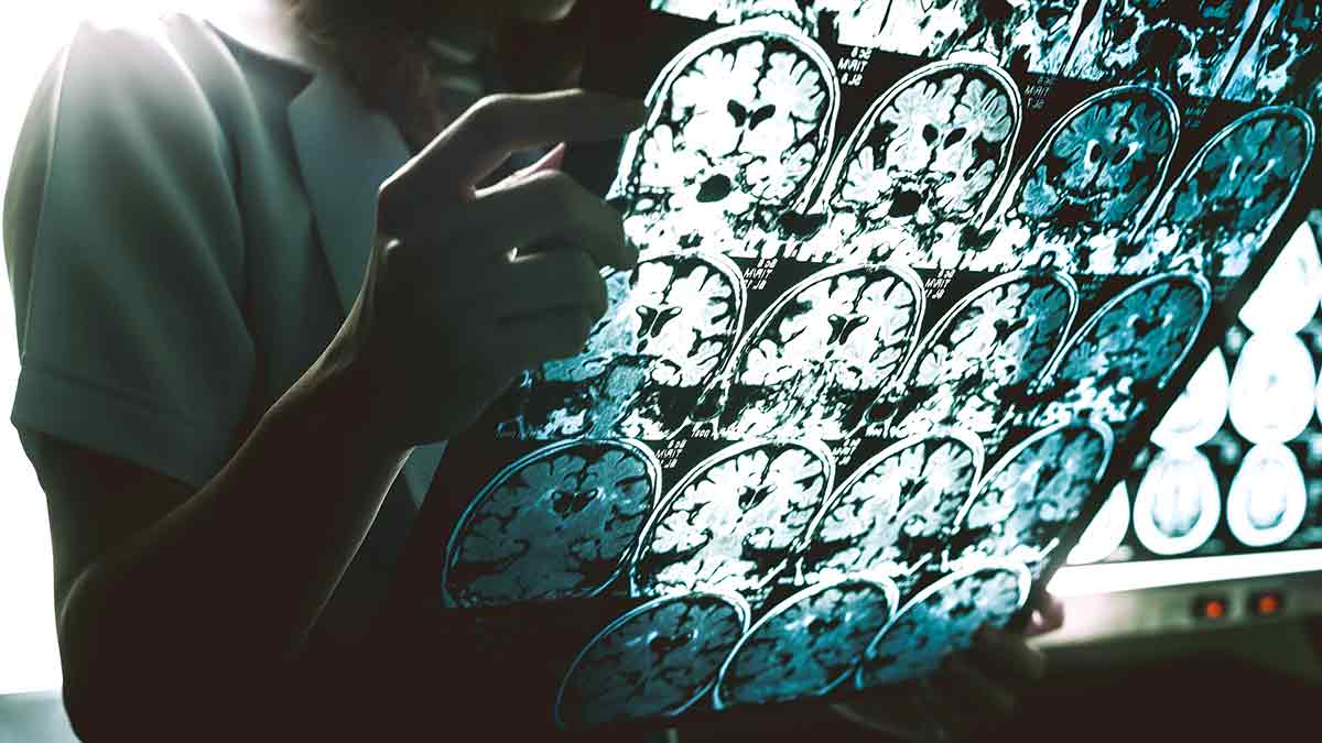 Understanding Alzheimer's disease: Symptoms, causes and treatment