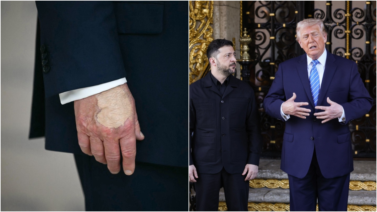 Concealer or IV bruises? Donald Trump's 'painted hands' spark health ...