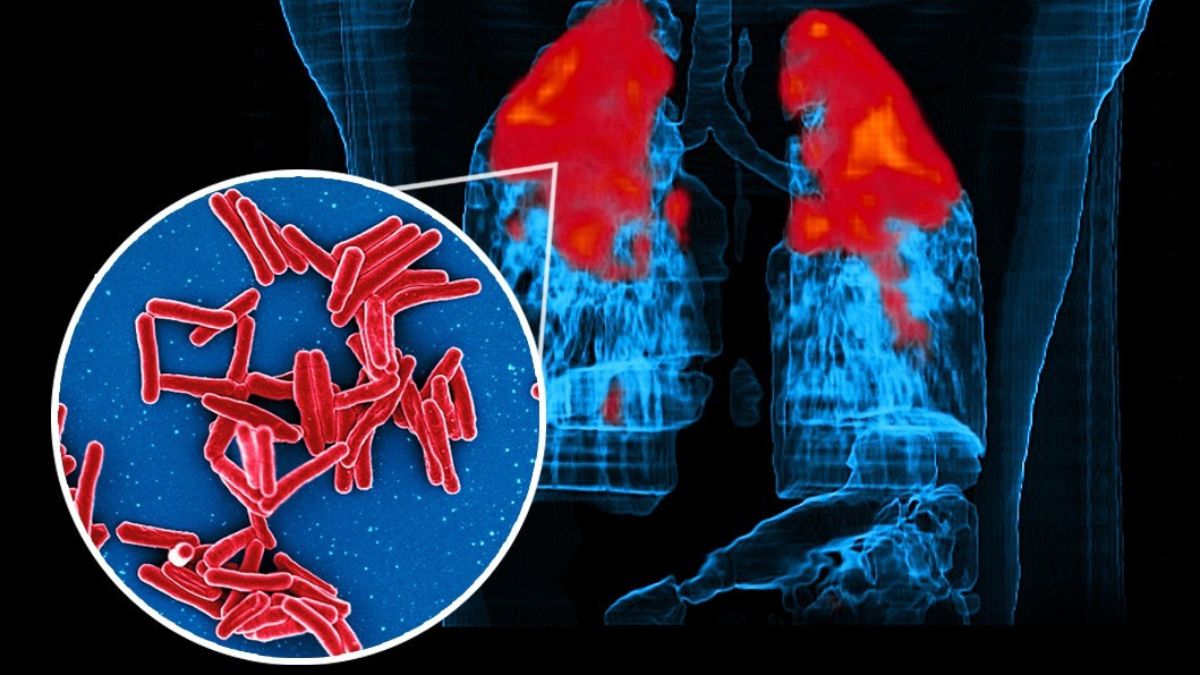 Científicos desvelan el misterio de la tuberculosis latente que persiste a pesar del tratamiento.
