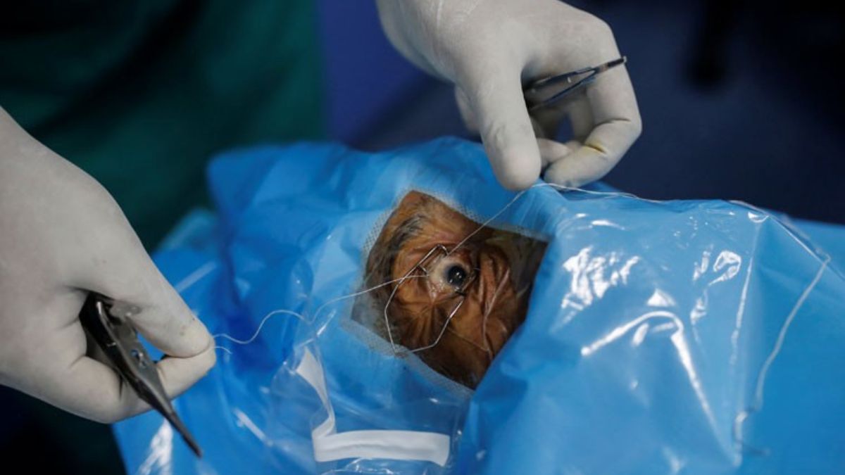 Half the world is still waiting for cataract surgery: Why millions still can’t access this simple eye treatment