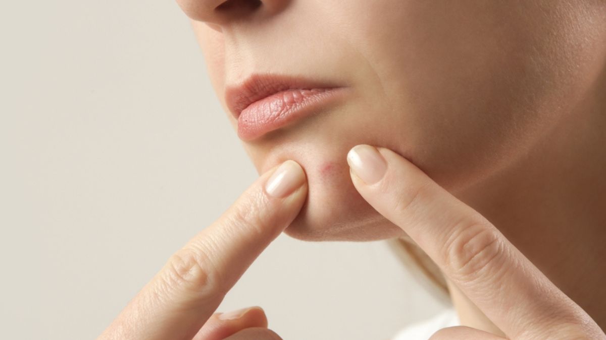 FACT CHECK: Are pimples a sign of lung, liver, or kidney disease?
